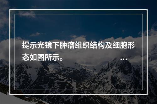 提示光镜下肿瘤组织结构及细胞形态如图所示。　　　　　　　　病