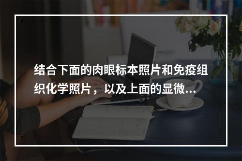 结合下面的肉眼标本照片和免疫组织化学照片，以及上面的显微镜检