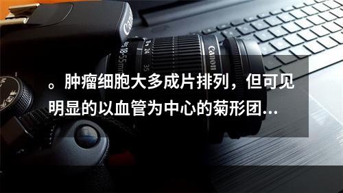 。肿瘤细胞大多成片排列，但可见明显的以血管为中心的菊形团结构