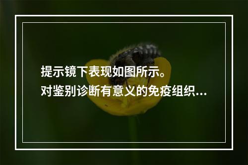 提示镜下表现如图所示。　　　　对鉴别诊断有意义的免疫组织化学