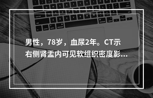 男性，78岁，血尿2年。CT示右侧肾盂内可见软组织密度影，肾