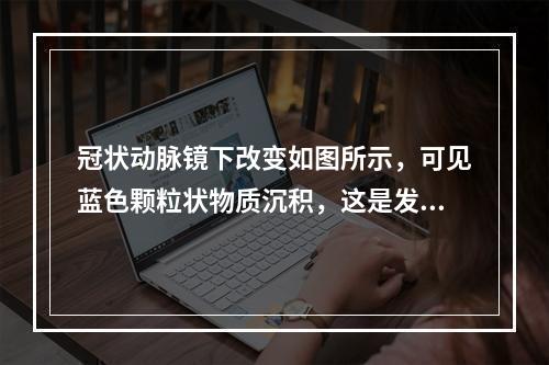 冠状动脉镜下改变如图所示，可见蓝色颗粒状物质沉积，这是发生了