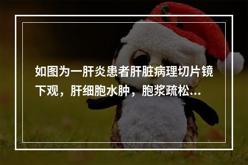 如图为一肝炎患者肝脏病理切片镜下观，肝细胞水肿，胞浆疏松化或