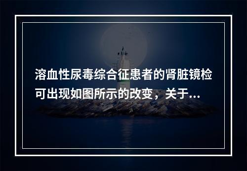 溶血性尿毒综合征患者的肾脏镜检可出现如图所示的改变，关于该疾