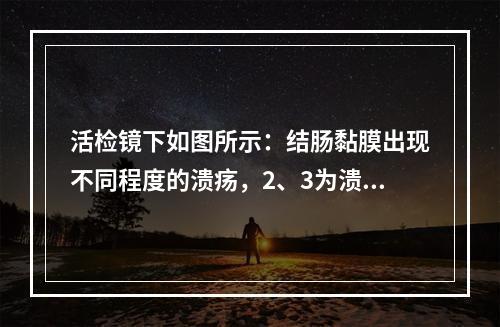 活检镜下如图所示：结肠黏膜出现不同程度的溃疡，2、3为溃疡底