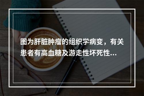 图为肝脏肿瘤的组织学病变，有关患者有高血糖及游走性坏死性红斑