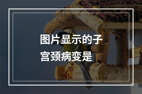 图片显示的子宫颈病变是