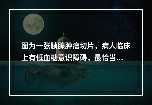 图为一张胰腺肿瘤切片，病人临床上有低血糖意识障碍，最恰当的诊