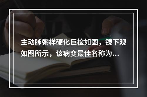 主动脉粥样硬化巨检如图，镜下观如图所示，该病变最佳名称为()