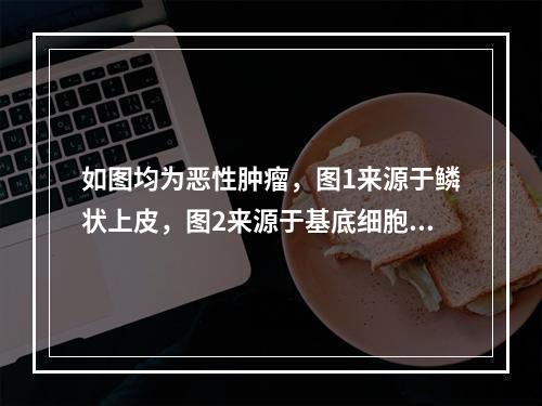 如图均为恶性肿瘤，图1来源于鳞状上皮，图2来源于基底细胞，图