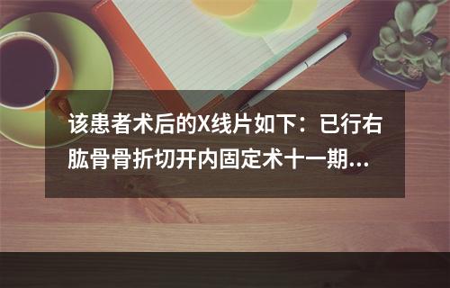 该患者术后的X线片如下：已行右肱骨骨折切开内固定术十一期右桡