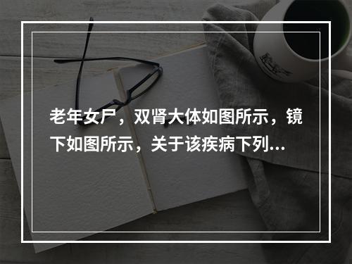 老年女尸，双肾大体如图所示，镜下如图所示，关于该疾病下列说法