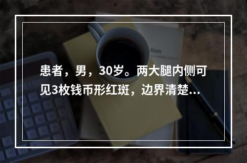 患者，男，30岁。两大腿内侧可见3枚钱币形红斑，边界清楚，中