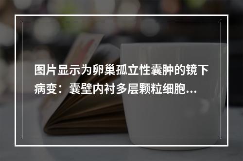 图片显示为卵巢孤立性囊肿的镜下病变：囊壁内衬多层颗粒细胞，其