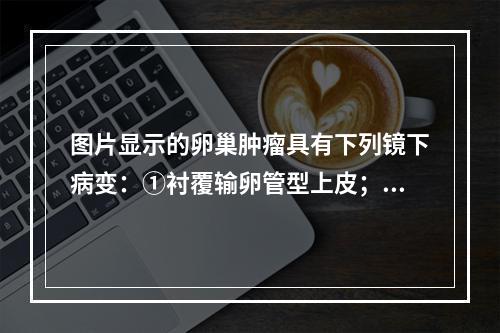 图片显示的卵巢肿瘤具有下列镜下病变：①衬覆输卵管型上皮；②具