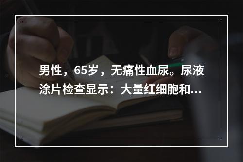 男性，65岁，无痛性血尿。尿液涂片检查显示：大量红细胞和少数