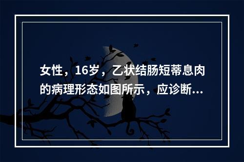 女性，16岁，乙状结肠短蒂息肉的病理形态如图所示，应诊断为