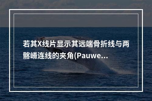 若其X线片显示其远端骨折线与两髂嵴连线的夹角(Pauwell