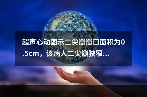 超声心动图示二尖瓣瓣口面积为0.5cm，该病人二尖瓣狭窄的程