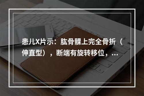 患儿X片示：肱骨髁上完全骨折（伸直型），断端有旋转移位，以下