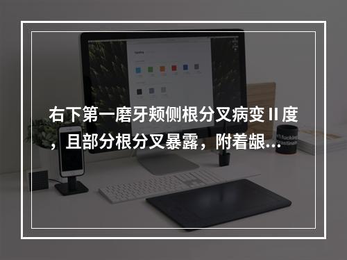 右下第一磨牙颊侧根分叉病变Ⅱ度，且部分根分叉暴露，附着龈较窄