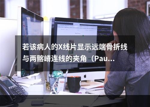 若该病人的X线片显示远端骨折线与两髂嵴连线的夹角（Pauwe