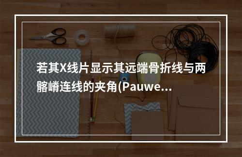 若其X线片显示其远端骨折线与两髂嵴连线的夹角(Pauwell