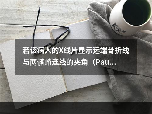 若该病人的X线片显示远端骨折线与两髂嵴连线的夹角（Pauwe