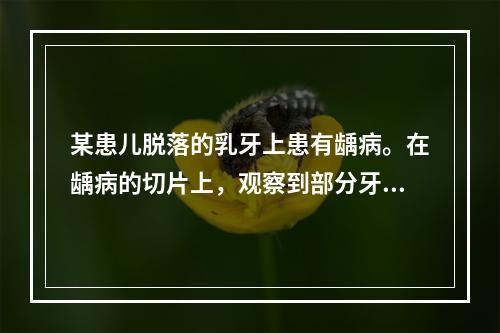 某患儿脱落的乳牙上患有龋病。在龋病的切片上，观察到部分牙本质