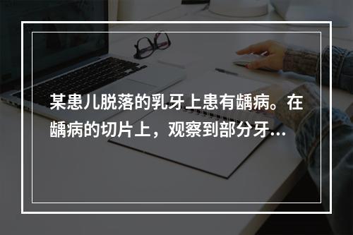 某患儿脱落的乳牙上患有龋病。在龋病的切片上，观察到部分牙本质