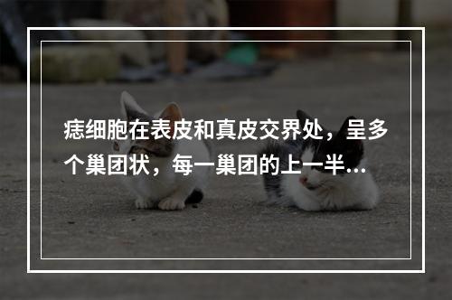 痣细胞在表皮和真皮交界处，呈多个巢团状，每一巢团的上一半在表