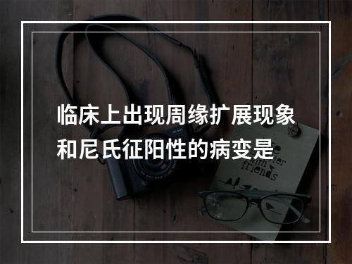 临床上出现周缘扩展现象和尼氏征阳性的病变是