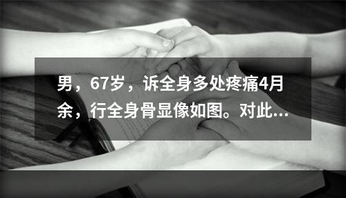 男，67岁，诉全身多处疼痛4月余，行全身骨显像如图。对此影像