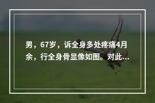 男，67岁，诉全身多处疼痛4月余，行全身骨显像如图。对此影像