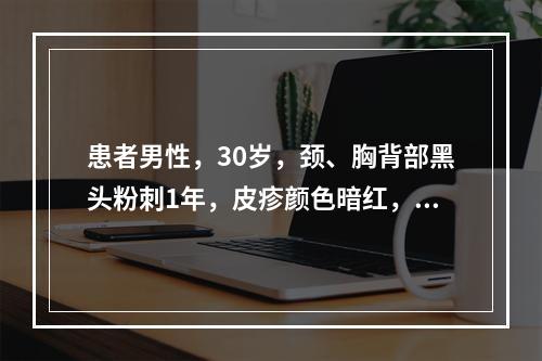 患者男性，30岁，颈、胸背部黑头粉刺1年，皮疹颜色暗红，以结