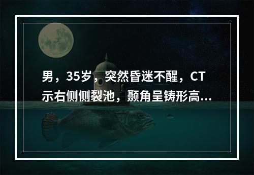 男，35岁，突然昏迷不醒，CT示右侧侧裂池，颞角呈铸形高密度