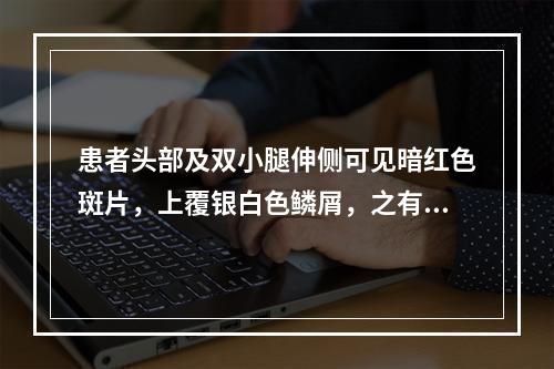 患者头部及双小腿伸侧可见暗红色斑片，上覆银白色鳞屑，之有点状