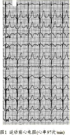 该患者运动前心电图表现为