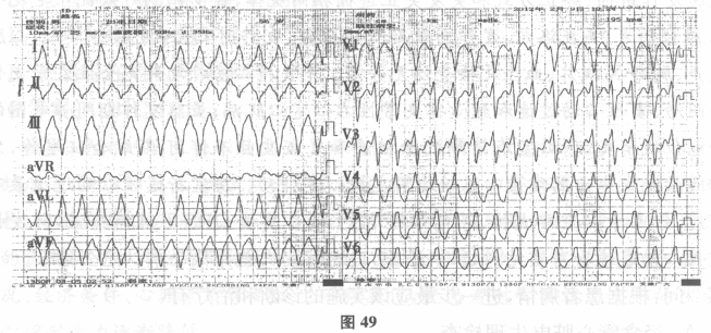 （提示：本次入院第3天行第2次心内射频。标测到右侧显性旁道后