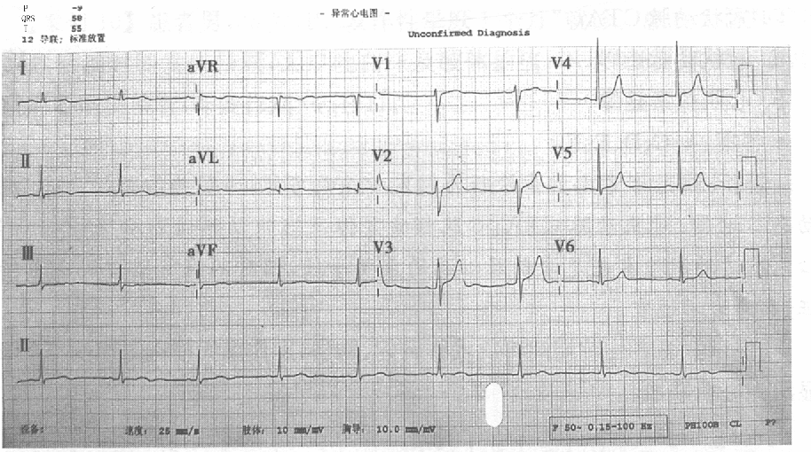 （提示：患者住院期间再次发作胸闷、胸痛，发作期间描记心电图见