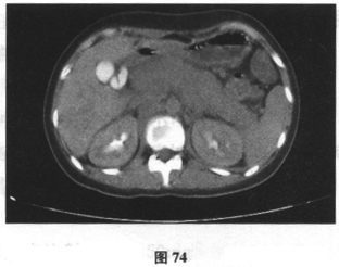 目前考虑患者的诊断及治疗方案为()