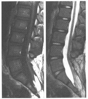 该患者脊柱MRI所见异常包括（）