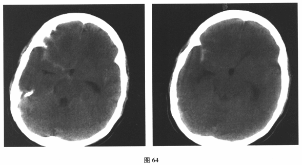 与烟雾病血管形成有关的因子包括()