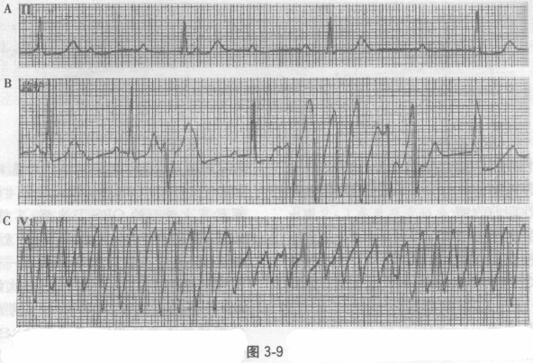 患者晕厥发生的直接原因最可能是由于