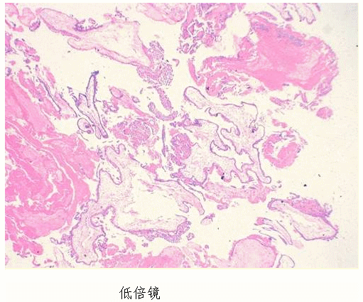 最不可能的病理诊断是