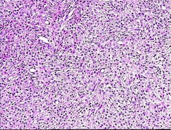 提示免疫组织化学检测：CD10（+）、SMA（-）、desm