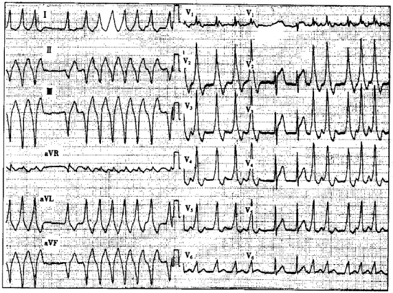 如果最短的RR间距为210ms，容易发生的并发症是