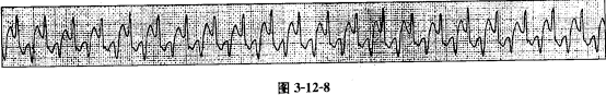 该类型心律失常除见于洋地黄中毒外，还常见于