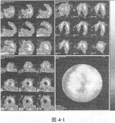 根据心肌灌注显像图，结合病史，最可能的诊断是