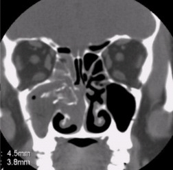 真菌性鼻窦炎的并发症，表述正确的是